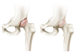 Artrose-heup-l-Advies-en-behandeling-l-Fysiotherapie Wieenhof Venray