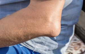 Bursitis olecrani Venray | Fysiotherapie Wieenhof | Vakkundig