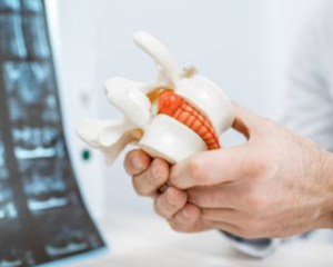 Hernia-l-Fysiotherapie-venray- fysio wieenhof