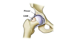 Heup-impingement-l-Fysiotherapie Wieenhof Venray