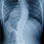 Scoliose-Fysiotherapie Wieenhof Venray