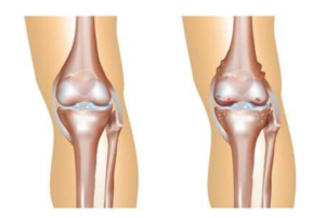 Artrose-knie-l-Advies-en-behandeling-l-Fysiotherapie wieenhof venray